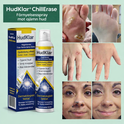 Nordfyn™ HudKlar™ ChillErase – Precisionskylande spray för slätare hud